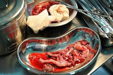 علت اصلی سقط جنین در ایران چیست؟!