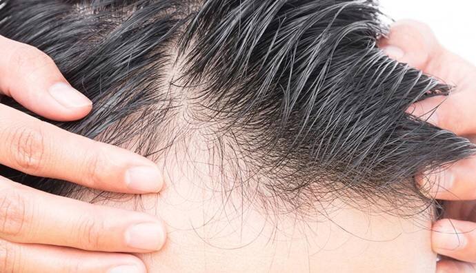 کمبود پتاسیم یکی از دلایل عمده ریزش مو