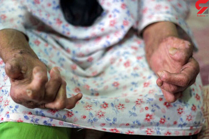 شیوع بیماری جذام در ایران پس از چند دهه شیوع بیماری جذام در ایران پس از چند دهه