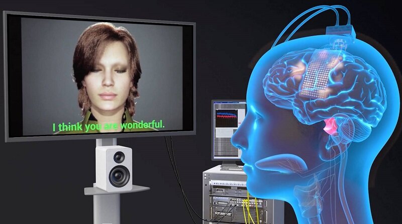 برگرداندن توانایی تکلم با هوش مصنوعی پس از سکته مغزی