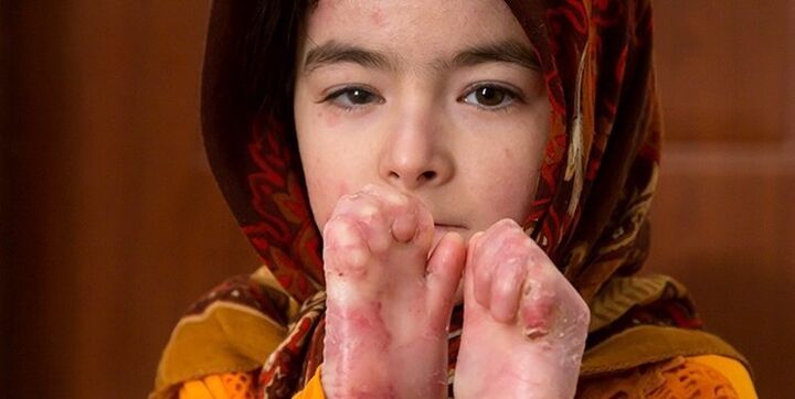 تسهیلات ویژه برای خانهدار شدن بیماران پروانهای در گلستان تسهیلات ویژه برای خانهدار شدن بیماران پروانهای در گلستان