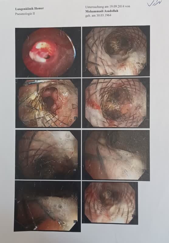 روایت جانباز شیمیایی ۷۰درصد کشورمان از روند درمانش