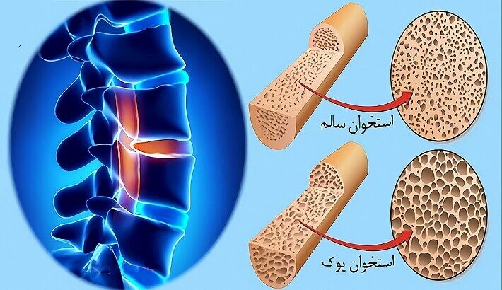 هشدار؛ شیوع قاتل خاموش در کشور/ کم توجهی بیمه ها به بیماری پوکی استخوان