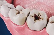 وضعیت اسفبار سلامت دهان و دندان در کشور/ بیمه ها کجای قصه‌اند؟!