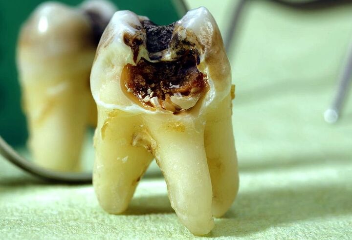 وضعیت اسفبار سلامت دهان و دندان در کشور/ بیمه ها کجای قصه‌اند؟!