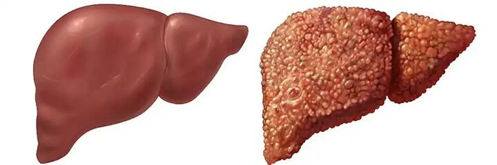 فعالیت فیزیکی و رژیم سالم راه حل درمان کبد چرب/ سرانه مصرف نوشابه شیرین در ایران بالا است فعالیت فیزیکی و رژیم سالم راه حل درمان کبد چرب/ سرانه مصرف نوشابه شیرین در ایران بالا است