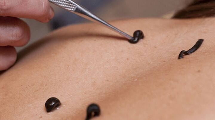 عرضه زالوی طبی در داروخانه مورد تائید است عرضه زالوی طبی در داروخانه مورد تائید است