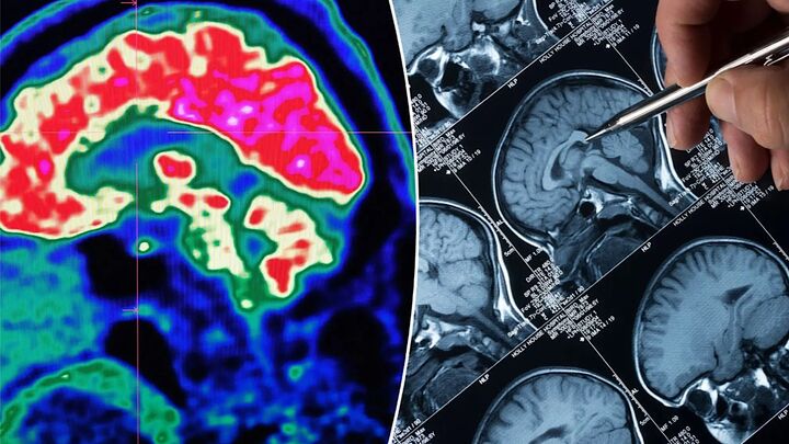 مرکز ملی نوآوری مغز در بیمارستان فیروزگر تهران راهاندازی میشود مرکز ملی نوآوری مغز در بیمارستان فیروزگر تهران راهاندازی میشود