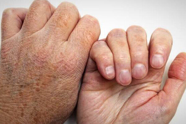 جذام قابل درمان است/ آمار ابتلا در جهان و ایران جذام قابل درمان است/ آمار ابتلا در جهان و ایران