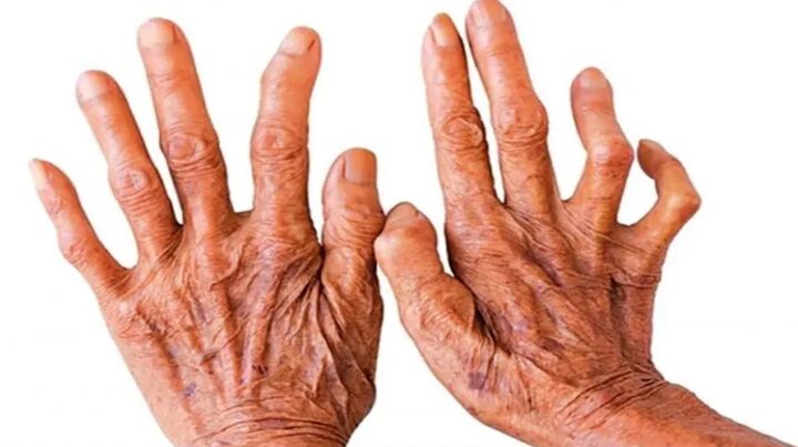 فقط 5 درصد مردم جذام میگیرند فقط 5 درصد مردم جذام میگیرند