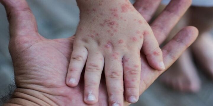 ضرورت تزریق واکسن سرخک برای افراد زیر ۱۵ سال/ فرد مبتلا به سرخک ۱۴ نفر را مبتلا میکند ضرورت تزریق واکسن سرخک برای افراد زیر ۱۵ سال/ فرد مبتلا به سرخک ۱۴ نفر را مبتلا میکند