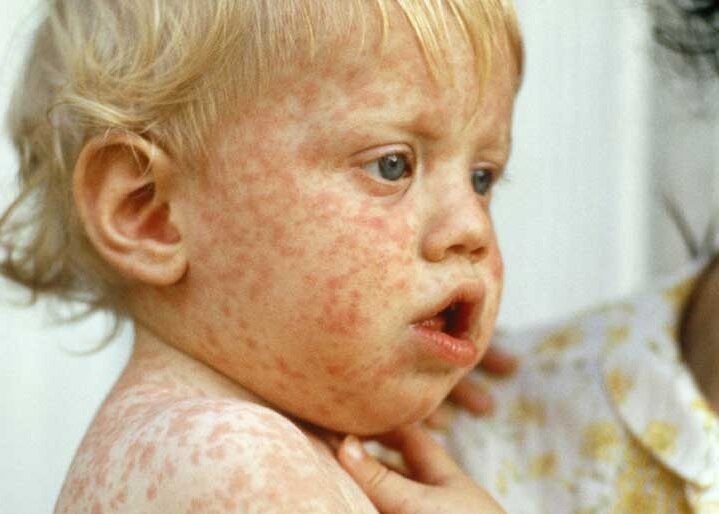 ضرورت تزریق واکسن سرخک برای افراد زیر ۱۵ سال/ فرد مبتلا به سرخک ۱۴ نفر را مبتلا میکند