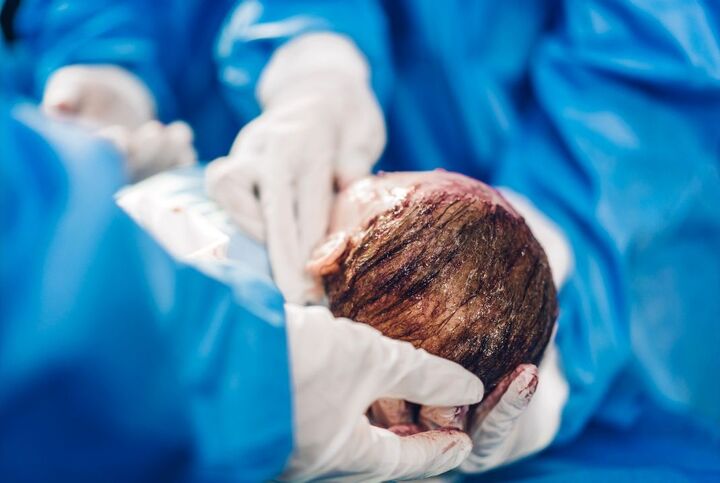 تشریح مشکلات عمل سزارین و احتمال بستری نوزاد در ICU تشریح مشکلات عمل سزارین و احتمال بستری نوزاد در ICU