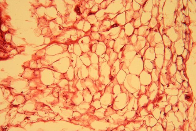 ارتباط عجیب چربیهای بدن با اضطراب ارتباط عجیب چربیهای بدن با اضطراب