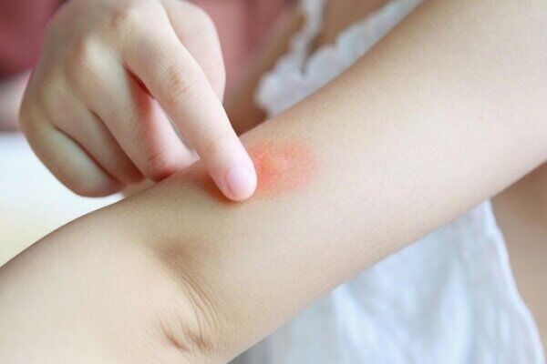 هشدار وزارت بهداشت درباره پشه آئدس هشدار وزارت بهداشت درباره پشه آئدس