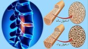 پوکی استخوان از دهه چهارم زندگی شروع می‌شود