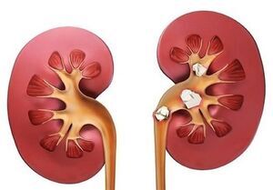 ایران روی کمربند سنگ کلیه قرار دارد