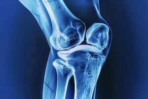 معجزه زردچوبه و زنجبیل برای ایمپلنت استخوان