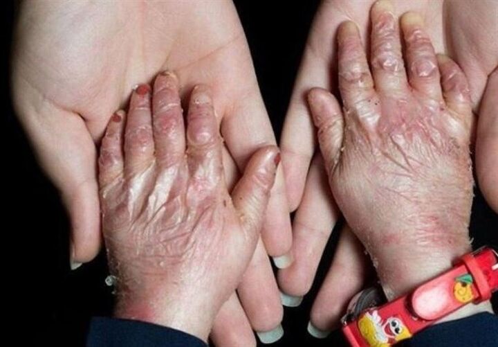 شناسایی 492 گونه بیماری نادر در ایران