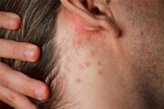 توصیه‌های بهداشتی برای جلوگیری از عرق‌سوز شدن در هوای گرم