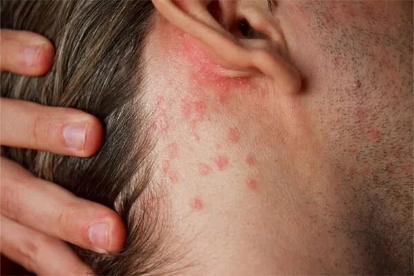 توصیه‌های بهداشتی برای جلوگیری از عرق‌سوز شدن در هوای گرم