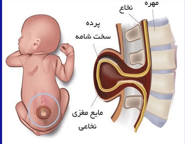 ۲ میلیون ایرانی مبتلا به «مننگوسل» هستند
