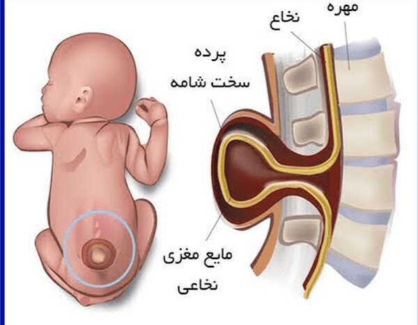 ۲ میلیون ایرانی مبتلا به «مننگوسل» هستند