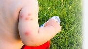 درمان‌های خانگی برای مقابله با گزش حشرات