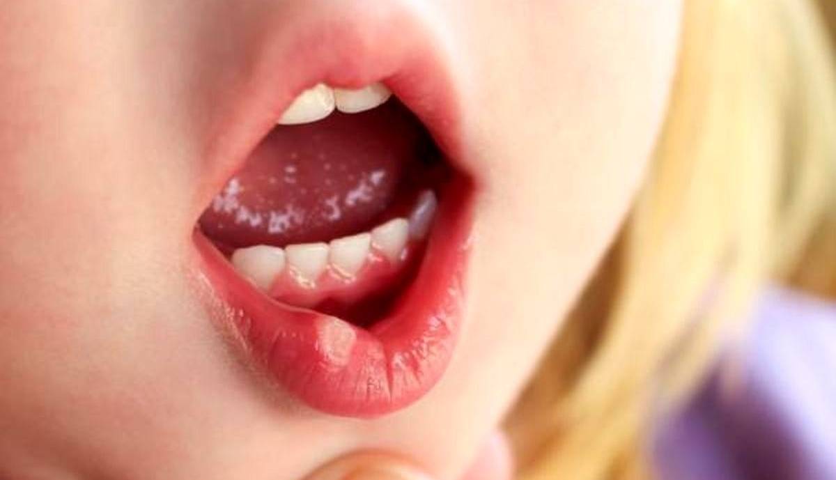 علت بروز آفت دهانی چیست؟