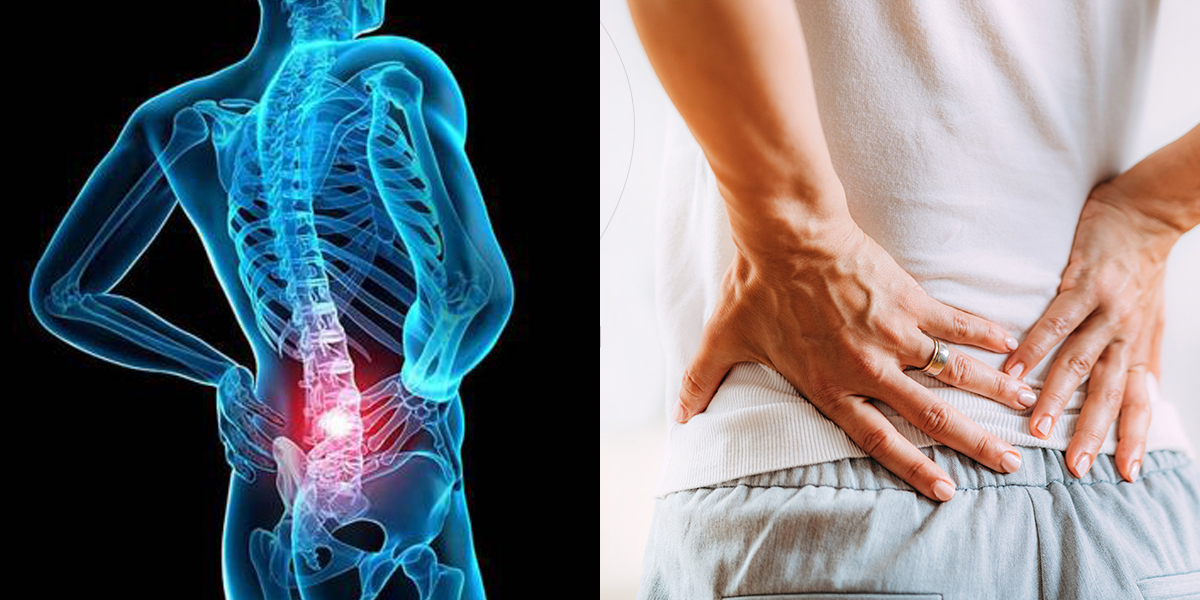 سیاتیک چیست و چطور با آن مقابله کنیم؟
